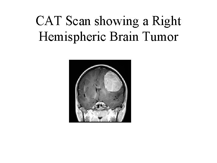 CAT Scan showing a Right Hemispheric Brain Tumor 