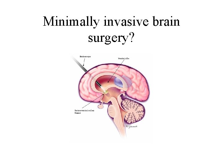 Minimally invasive brain surgery? 