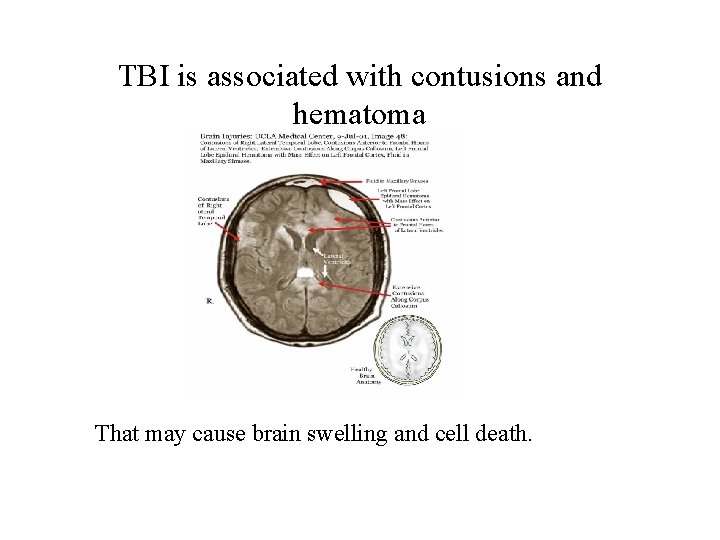 TBI is associated with contusions and hematoma That may cause brain swelling and cell