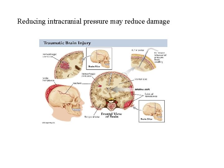 Reducing intracranial pressure may reduce damage 