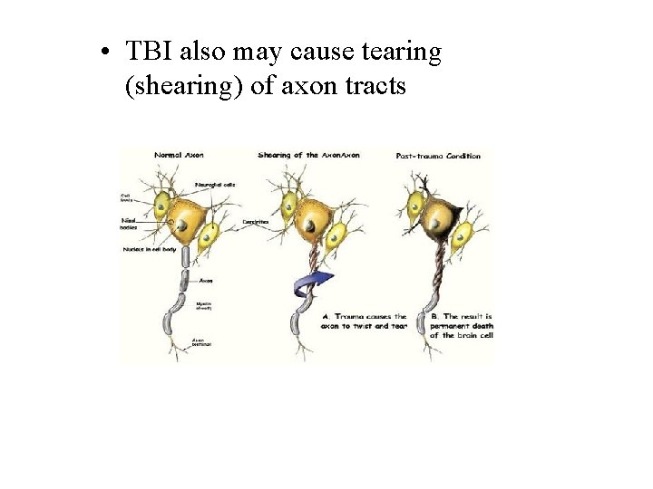  • TBI also may cause tearing (shearing) of axon tracts 