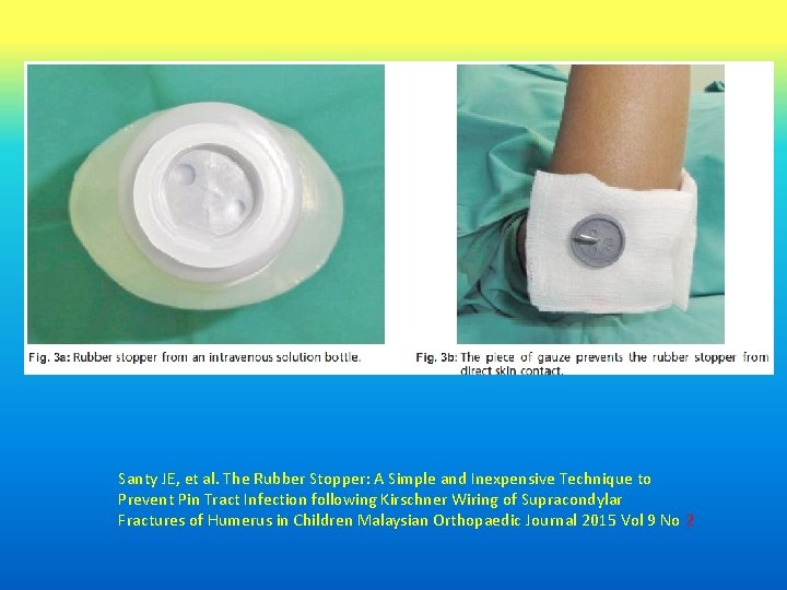  Santy JE, et al. The Rubber Stopper: A Simple and Inexpensive Technique to