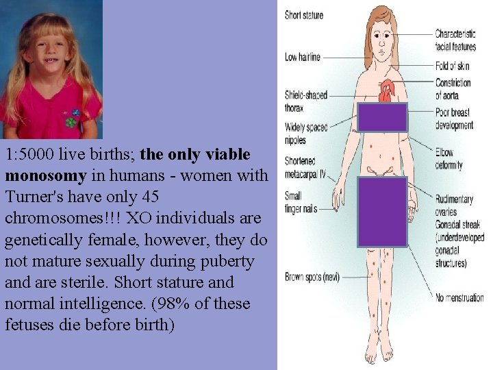 1: 5000 live births; the only viable monosomy in humans - women with Turner's