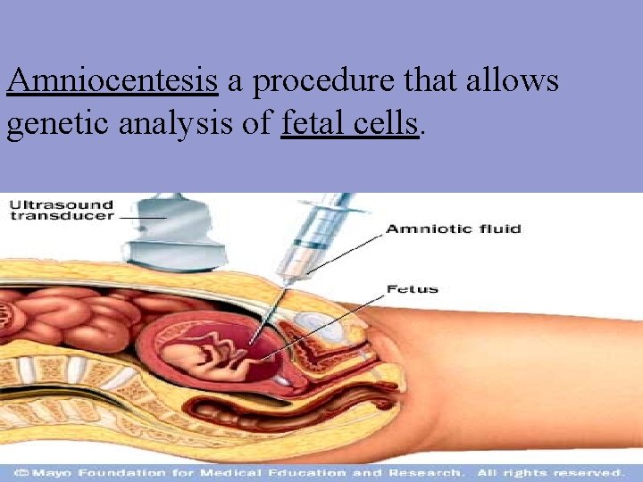 Amniocentesis a procedure that allows genetic analysis of fetal cells. 