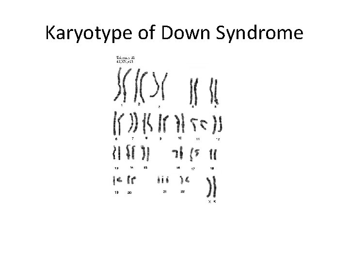 Karyotype of Down Syndrome 