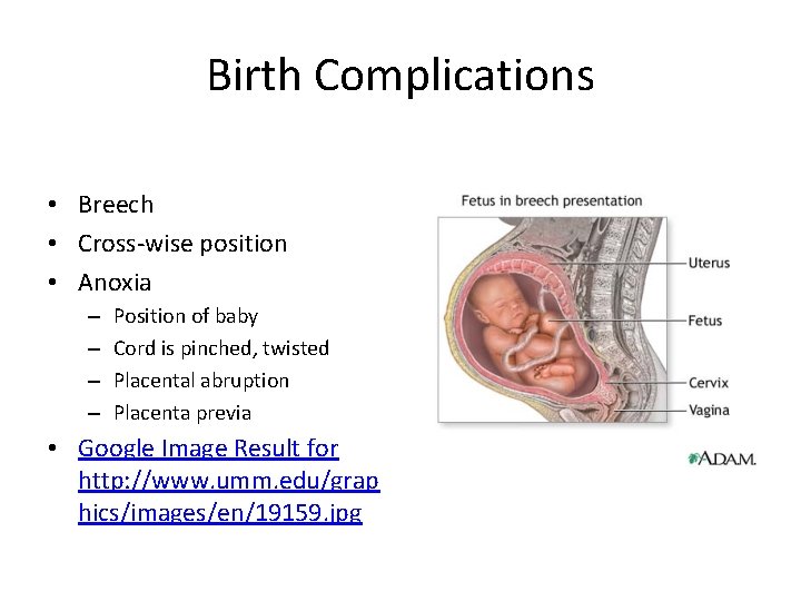 Birth Complications • Breech • Cross-wise position • Anoxia – – Position of baby