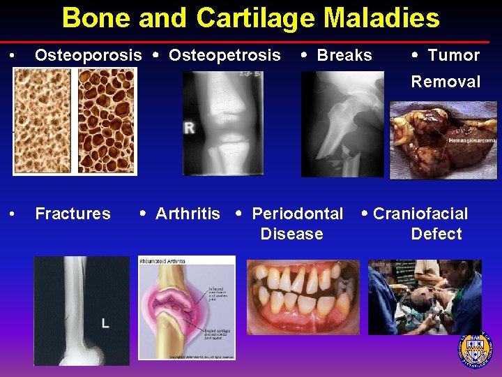 Bone and Cartilage Maladies • Osteoporosis Osteopetrosis Breaks Tumor Removal • Fractures Arthritis Periodontal