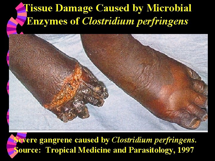 Tissue Damage Caused by Microbial Enzymes of Clostridium perfringens Severe gangrene caused by Clostridium
