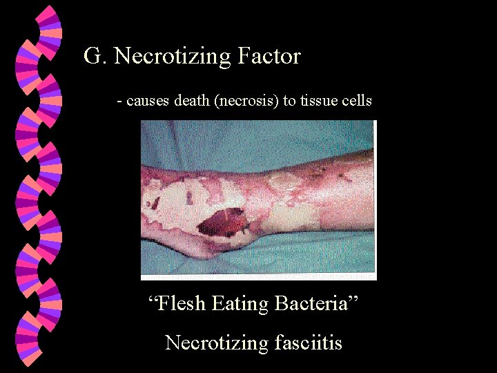 G. Necrotizing Factor - causes death (necrosis) to tissue cells “Flesh Eating Bacteria” Necrotizing