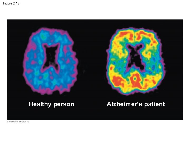 Figure 2. 4 B Healthy person Alzheimer’s patient 