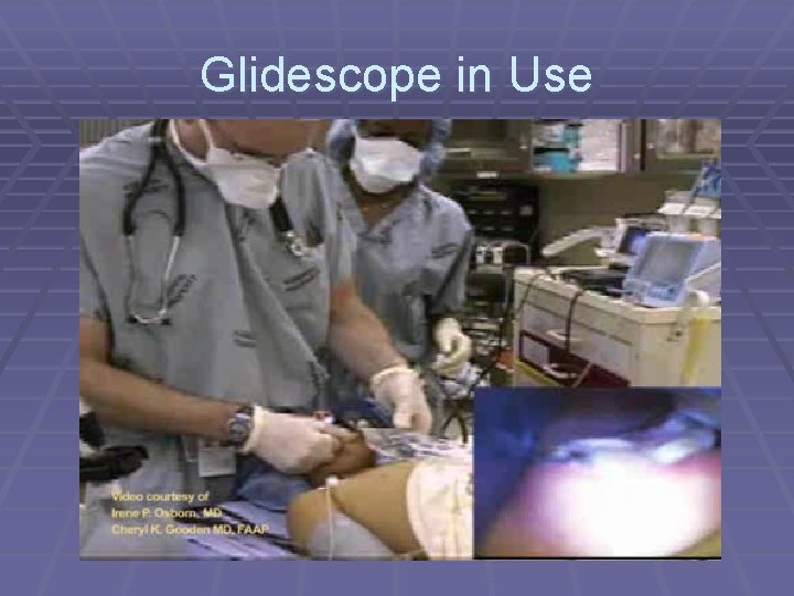 Glidescope in Use 