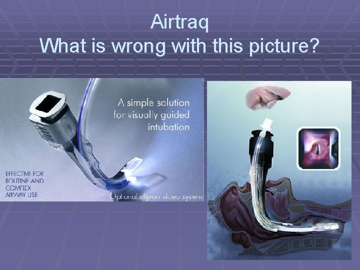 Airtraq What is wrong with this picture? 