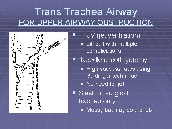 Trans Trachea Airway FOR UPPER AIRWAY OBSTRUCTION § TTJV (jet ventilation) § difficult with