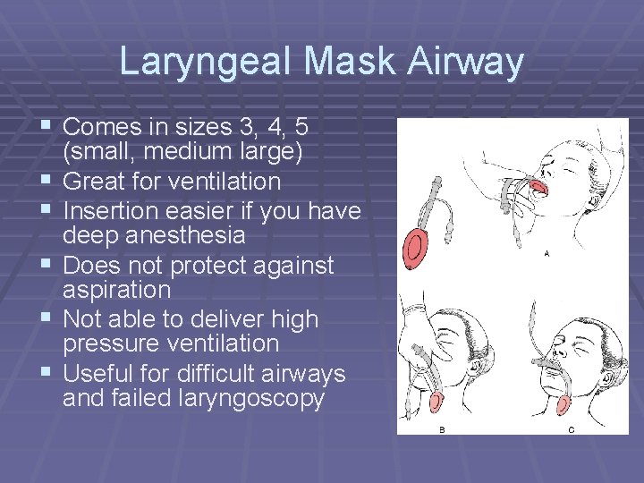 Laryngeal Mask Airway § Comes in sizes 3, 4, 5 § § § (small,