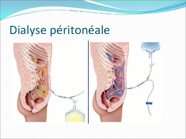 Dialyse péritonéale 