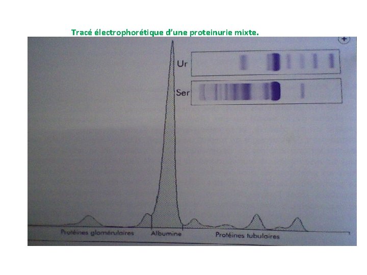 Tracé électrophorétique d’une proteinurie mixte. 