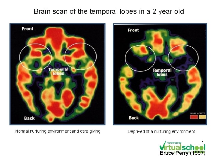 Brain scan of the temporal lobes in a 2 year old Normal nurturing environment