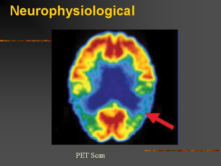 Neurophysiological PET Scan 
