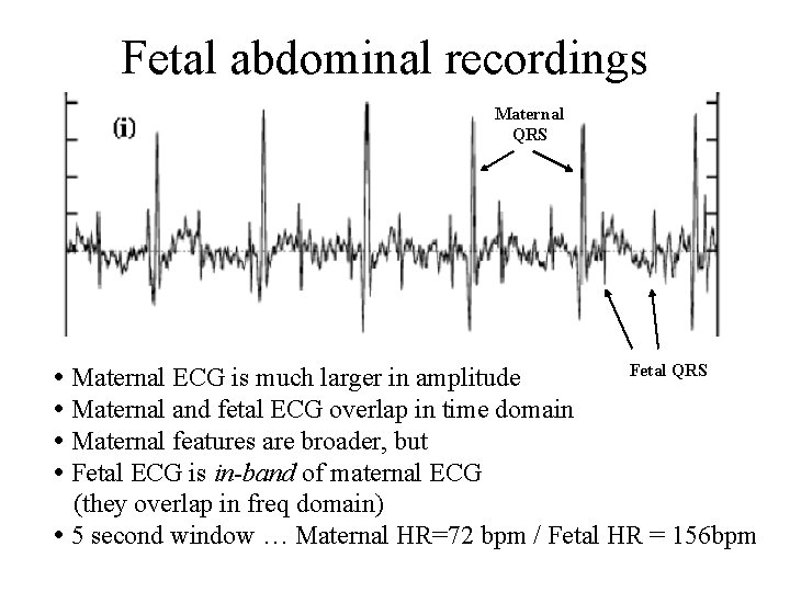 Fetal abdominal recordings Maternal QRS • Maternal ECG is much larger in amplitude •