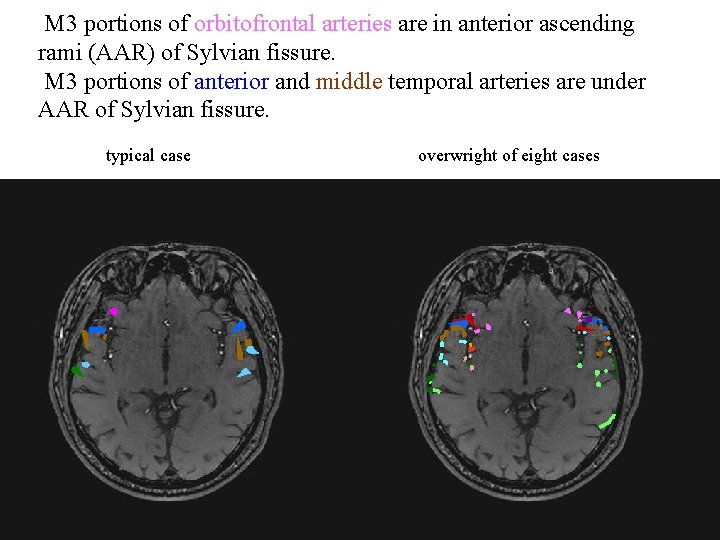 M 3 portions of orbitofrontal arteries are in anterior ascending rami (AAR) of Sylvian