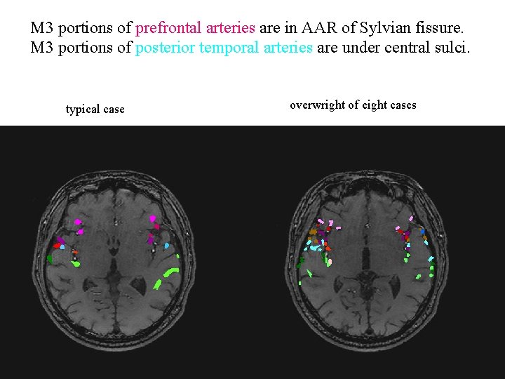 M 3 portions of prefrontal arteries are in AAR of Sylvian fissure. M 3