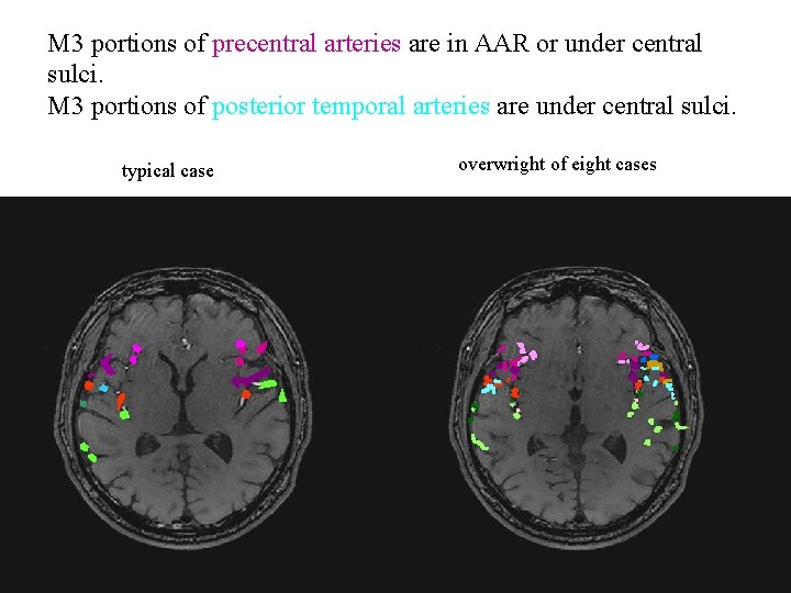 M 3 portions of precentral arteries are in AAR or under central sulci. M