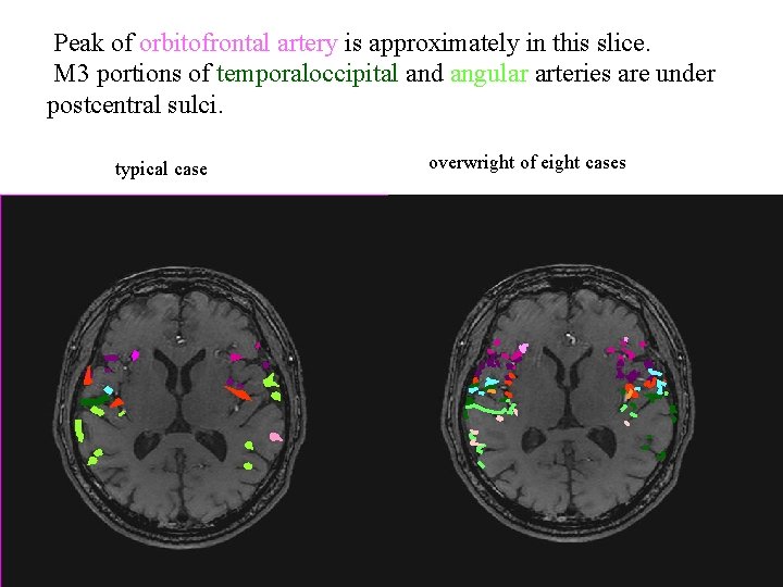 Peak of orbitofrontal artery is approximately in this slice. M 3 portions of temporaloccipital