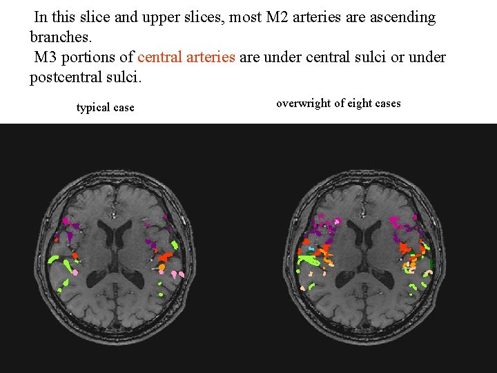 In this slice and upper slices, most M 2 arteries are ascending branches. M