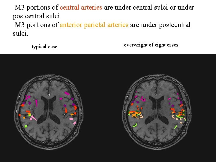 M 3 portions of central arteries are under central sulci or under postcentral sulci.