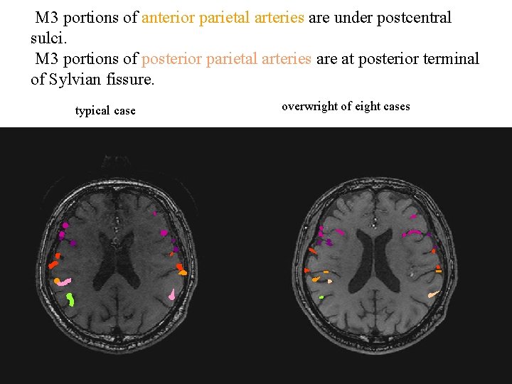 M 3 portions of anterior parietal arteries are under postcentral sulci. M 3 portions