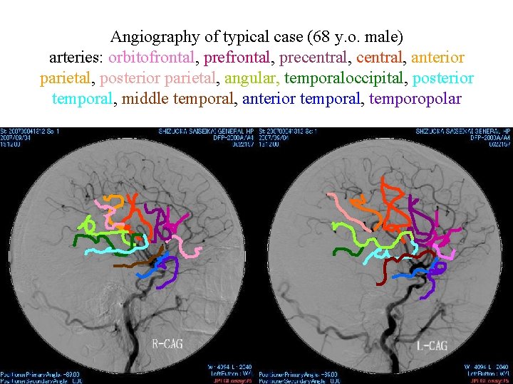 Angiography of typical case (68 y. o. male) arteries: orbitofrontal, precentral, anterior parietal, posterior