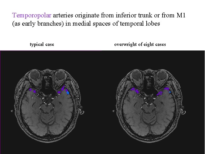 Temporopolar arteries originate from inferior trunk or from M 1 (as early branches) in