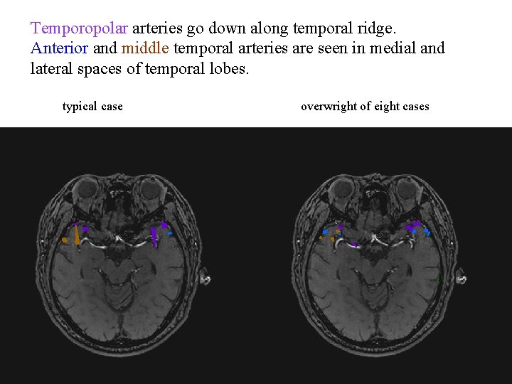 Temporopolar arteries go down along temporal ridge. Anterior and middle temporal arteries are seen