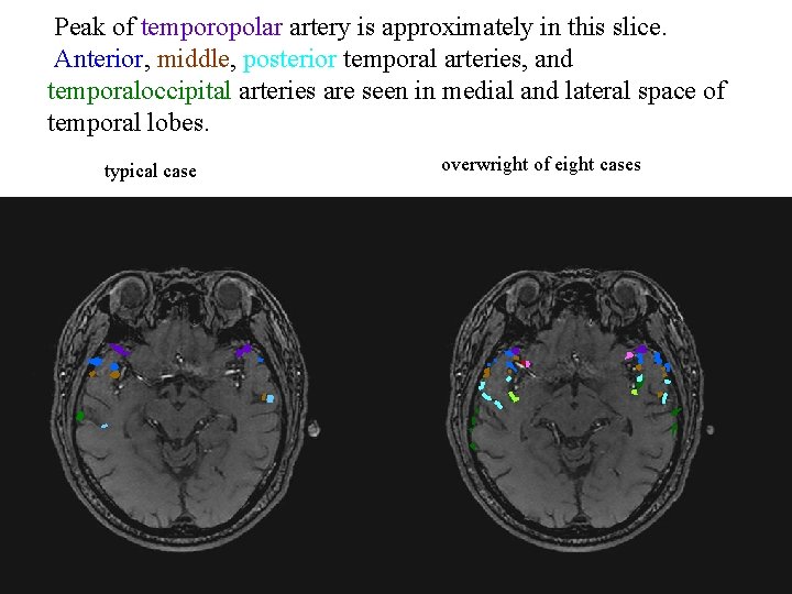 Peak of temporopolar artery is approximately in this slice. Anterior, middle, posterior temporal arteries,