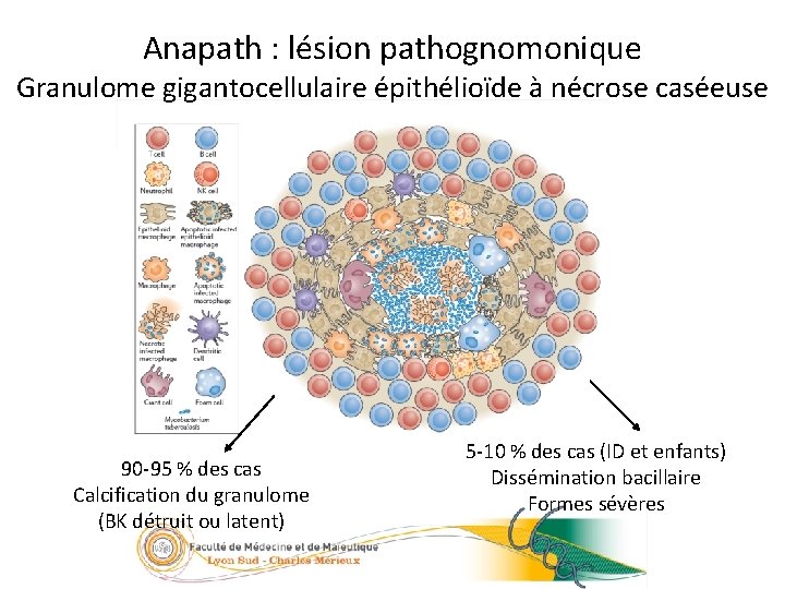 Anapath : lésion pathognomonique 10/23 Granulome gigantocellulaire épithélioïde à nécrose caséeuse 90 -95 %