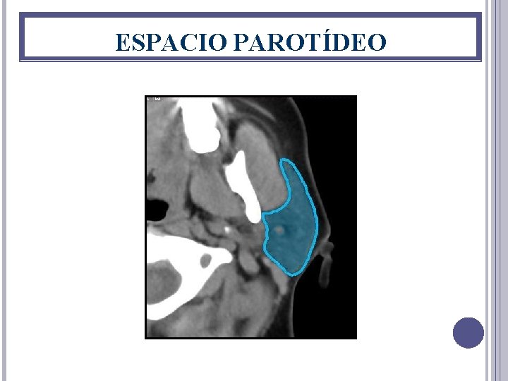 ESPACIO PAROTÍDEO 