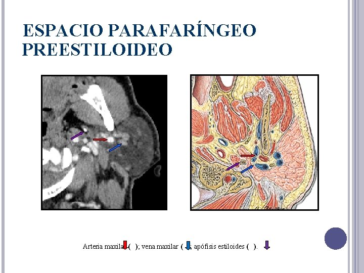 ESPACIO PARAFARÍNGEO PREESTILOIDEO Arteria maxilar ( ); vena maxilar ( ); apófisis estiloides (