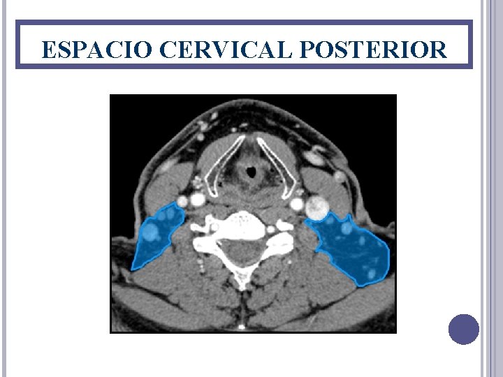 ESPACIO CERVICAL POSTERIOR 