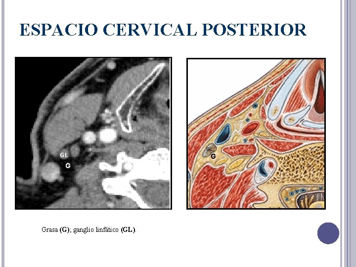 ESPACIO CERVICAL POSTERIOR GL G Grasa (G); ganglio linfático (GL). GL G 