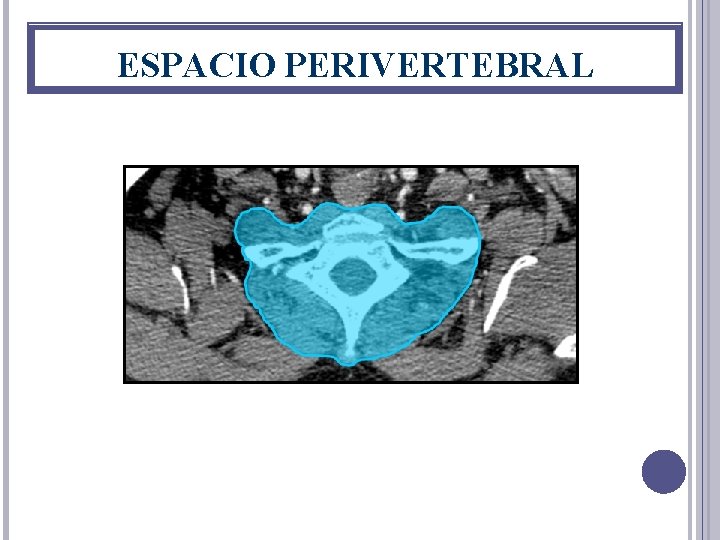 ESPACIO PERIVERTEBRAL 