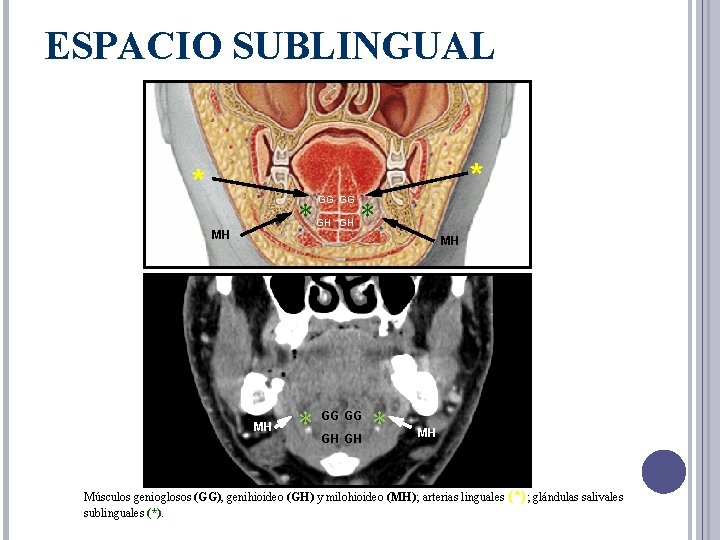 ESPACIO SUBLINGUAL * * MH GG GG GH GH * * MH MH *