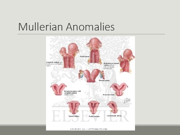 Mullerian Anomalies Mullerian Anomalies