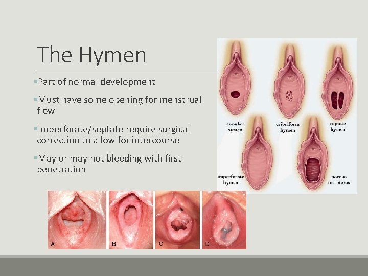 The Hymen §Part of normal development §Must have some opening for menstrual flow §Imperforate/septate The Hymen §Part of normal development §Must have some opening for menstrual flow §Imperforate/septate