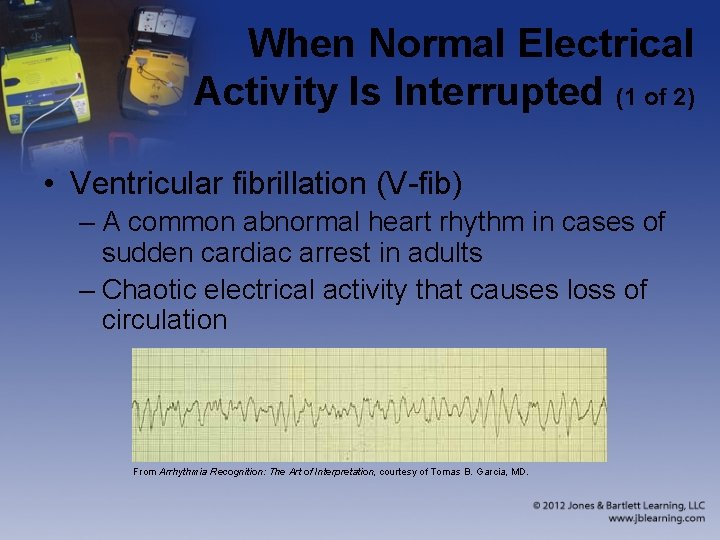 When Normal Electrical Activity Is Interrupted (1 of 2) • Ventricular fibrillation (V-fib) –