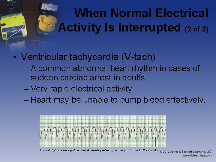 When Normal Electrical Activity Is Interrupted (2 of 2) • Ventricular tachycardia (V-tach) –