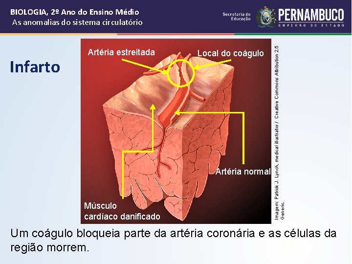 Infarto Artéria estreitada Local do coágulo Artéria normal Músculo cardíaco danificado Imagem: Patrick J.