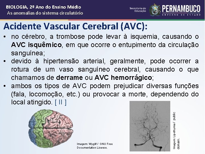 BIOLOGIA, 2º Ano do Ensino Médio As anomalias do sistema circulatório Acidente Vascular Cerebral