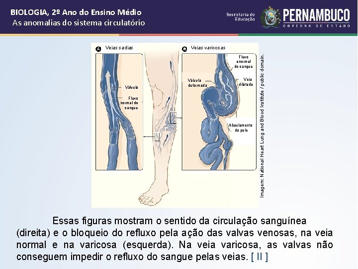 BIOLOGIA, 2º Ano do Ensino Médio As anomalias do sistema circulatório Veias varicosas Fluxo