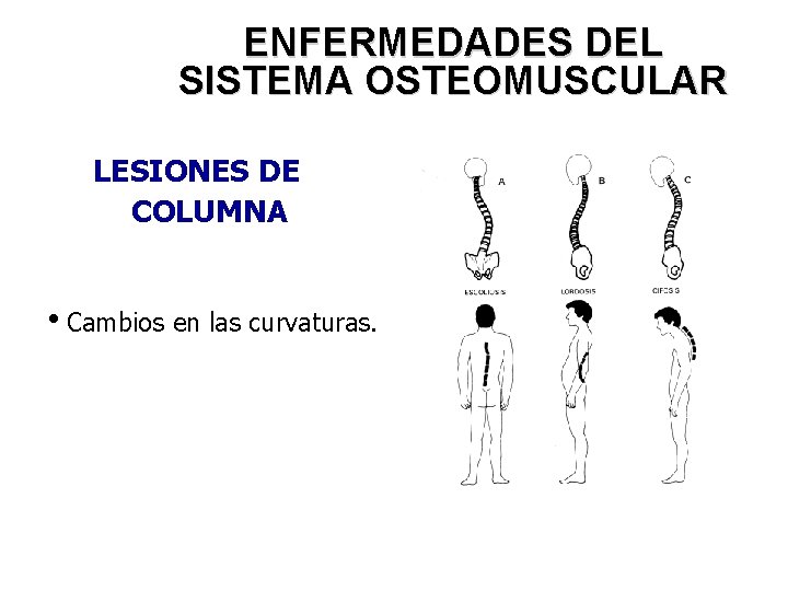 ENFERMEDADES DEL SISTEMA OSTEOMUSCULAR LESIONES DE COLUMNA i. Cambios en las curvaturas. 