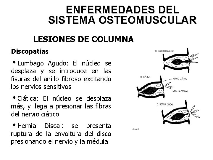 ENFERMEDADES DEL SISTEMA OSTEOMUSCULAR LESIONES DE COLUMNA Discopatias i. Lumbago Agudo: El núcleo se